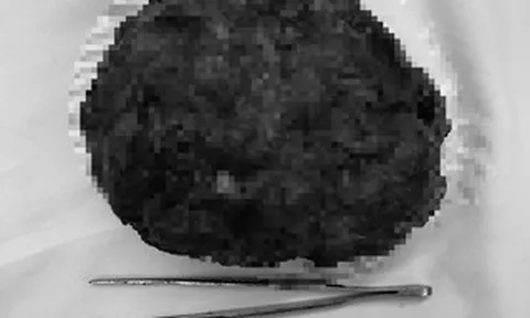 Cô gái trẻ về nước mổ u vú 17 cm, giữ được “vòng một”