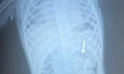 Dị vật sắc nhọn nằm trong dạ dày bệnh nhi 21 tháng tuổi