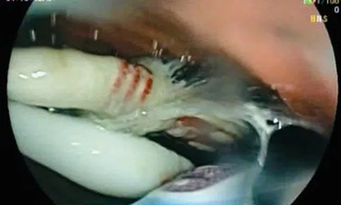 Người đàn ông nuốt cùng lúc 3 bàn chải đánh răng vào bụng