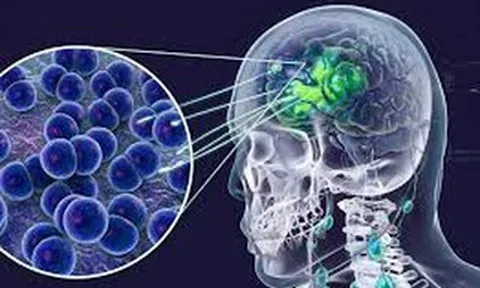 Cà Mau cập nhật thông tin vụ 2 ca não mô cầu