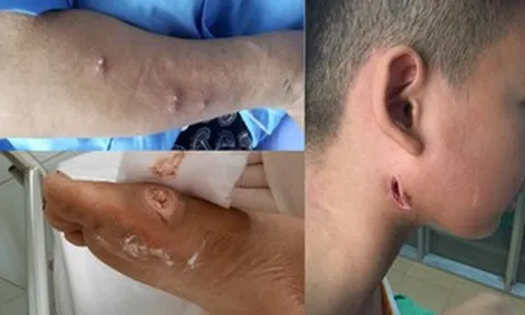 Bộ Y tế nói gì về bệnh "sốt đất" (Whitmore) sau 23 ca tử vong ở Thái Lan?