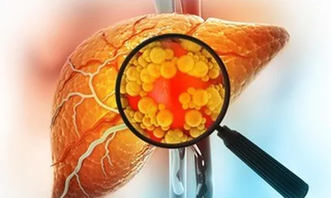 Đảo ngược gan nhiễm mỡ không cần ăn kiêng: Đột phá từ Mỹ