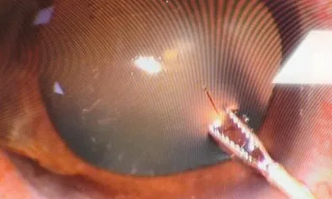 Một trường hợp cấp cứu hi hữu: Bệnh nhân bị ong chích xuyên giác mạc