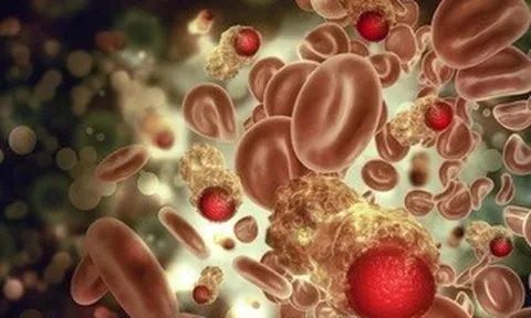 Nghiên cứu 25 năm chỉ ra 2 dấu hiệu nguy hiểm của ung thư máu