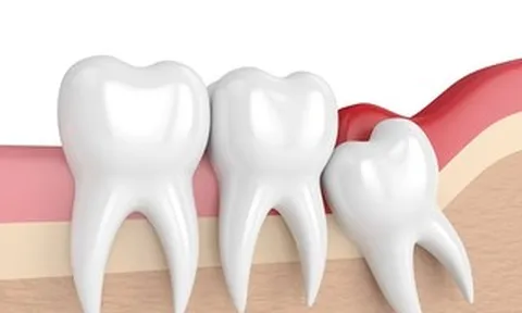 Nhổ răng khôn có được BHYT chi trả?