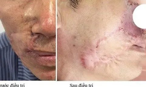 Ung thư da tái phát sau nhiều lần mổ, lan ngầm dưới da