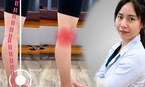 Bài tập cải thiện tình trạng ưỡn gối, cong chân: Chăm tập mỗi ngày chị em sớm có chân thẳng, tránh thoái hóa khớp gối