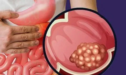 Phát hiện ung thư giai đoạn 4 ở tuổi 26, nam thanh niên hối hận: Giá như tôi không bỏ qua triệu chứng này