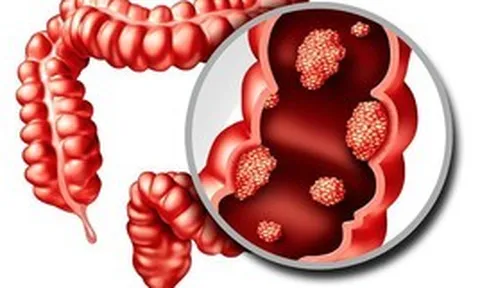 6 dấu hiệu cảnh báo đỏ của "căn bệnh ung thư đáng sợ": Có 1 cũng cần đi khám ngay!