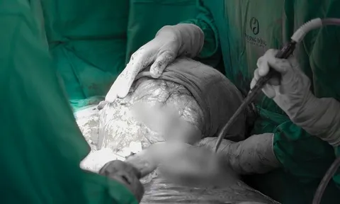 Người phụ nữ ở Hà Nội suy kiệt vì mang khối u khổng lồ 5kg