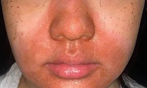 Cô gái trẻ nhập viện với gương mặt đỏ rực, bong tróc sau peel da