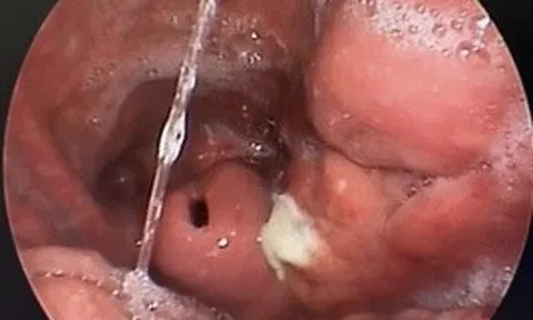 Hà Nội: Người đàn ông 66 tuổi tắc đường thở, phải nhập viện cấp cứu vì thói quen nhai đá lạnh giải nhiệt