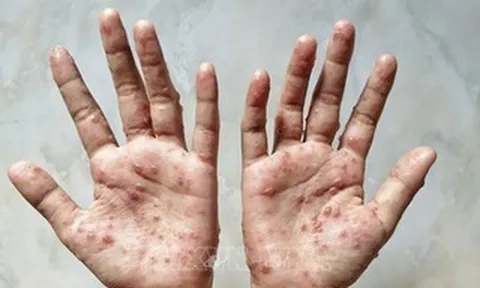 TPHCM có ca đậu mùa khỉ: Bác sĩ lưu ý dấu hiệu cần khám sớm