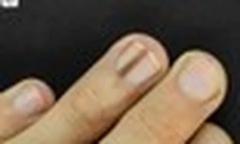 Bác sĩ bệnh viện trung ương cảnh báo: 5 dấu hiệu trên móng tay cần nghĩ tới ung thư ác tính