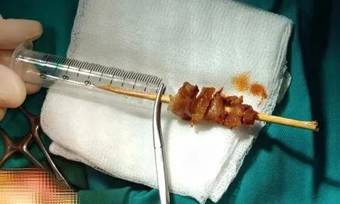 Bé 2 tuổi gặp sự cố nguy hiểm với que xiên thịt trong lúc chạy nhảy