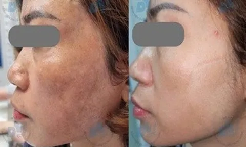 Nám da có nên điều trị bằng laser?
