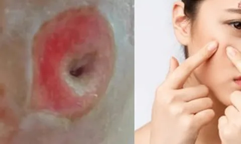 Người phụ nữ 40 tuổi chết lặng khi thấy mặt như "tổ ong" vì sai lầm ai cũng dễ mắc