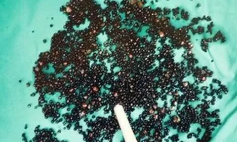 Đau bụng suốt nhiều tháng, người đàn ông 43 tuổi sốc nặng khi bác sĩ gắp ra thứ "đáng sợ" trong bụng
