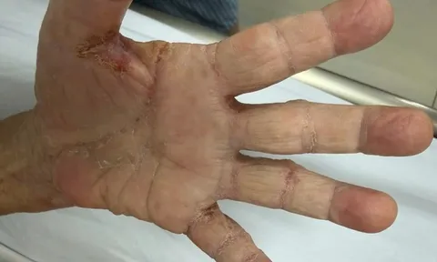 Một gia đình bị loài ký sinh trùng tưởng đã "biến mất" từ lâu tấn công