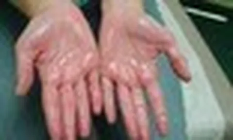 Khuyên thật: Thấy 5 thứ trên bàn tay phải đi khám thận ngay!