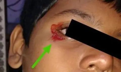 Bé trai 11 tuổi khóc ra máu khiến bác sĩ kinh ngạc