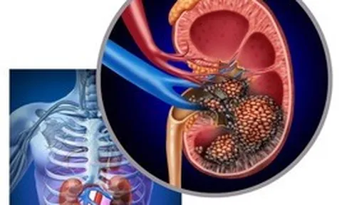 Người đàn ông bất ngờ phát hiện ung thư thận khi đi khám sức khỏe định kỳ: Tôi mới 32 tuổi, sao có thể...
