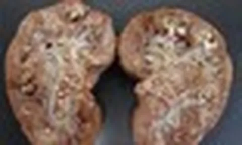 Người phụ nữ 58 tuổi thận bám đầy mủ, suýt mất thận: BS cảnh báo tuyệt đối không trì hoãn đi bệnh viện khi cơ thể phát tín hiệu