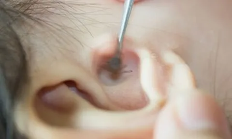 Chơi với thú cưng, bé gái 2 tuổi có bọ chét ký sinh trong tai