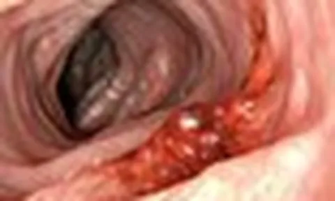 3 thói quen "dẫn lối" cho ung thư đại trực tràng: Gặp ở nhiều người Việt