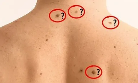 Nổi nhiều nốt ruồi là dấu hiệu ung thư?