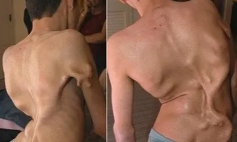 Bé gái 12 tuổi mắc hội chứng "người hóa đá" cực hiếm, cả triệu người mới có một ca