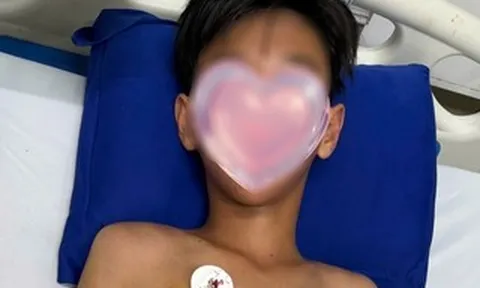 Bé trai ở Cà Mau bị ong vò vẽ đốt hơn 50 vết