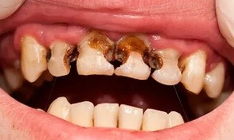 Trẻ thiếu canxi thường phát ra 5 tín hiệu: Bệnh viện Nhi đồng 2 cảnh báo đừng chủ quan