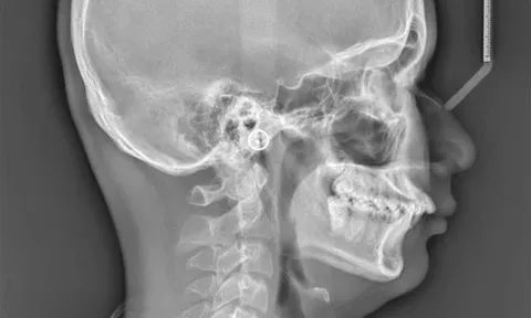 Tiếng ngáy ở trẻ em cảnh báo dấu hiệu không nên bỏ qua