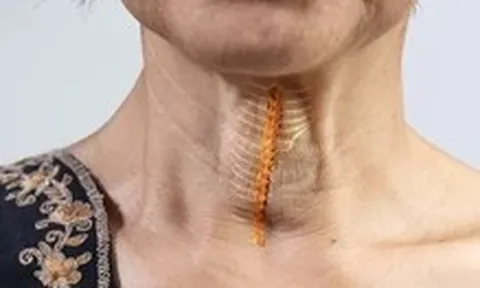 Vì sao mắc xương cá có thể đe dọa đến tính mạng?