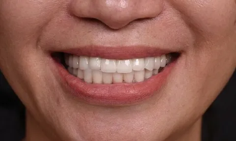 Những trường hợp nào không nên làm răng sứ?
