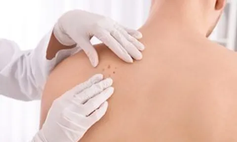 Đây là dấu hiệu sớm nhất của ung thư da nhưng rất hay bị bỏ qua