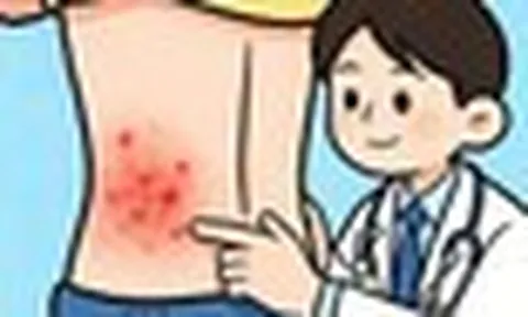 Đau đến mất ngủ nhiều đêm, bệnh zona thần kinh không còn là "bệnh người già": Cảnh báo 4 dấu hiệu miễn dịch suy yếu mà người trẻ bỏ qua