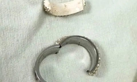 Cấp cứu nam thanh niên bị thắt nghẹt dương vật do đeo 'cock ring'