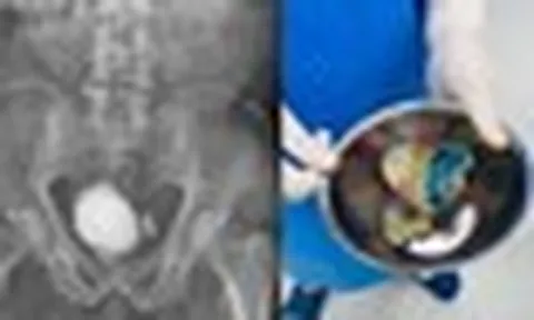 Bác sĩ kinh ngạc khi lấy ra “khối đá” gần nửa kg trong bàng quang bệnh nhân: Cảnh báo thói quen nhiều người mắc