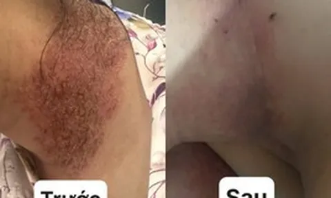 Khổ sở quấn khăn quanh người nhiều năm vì căn bệnh da liễu hiếm gặp