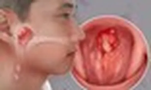 Con bị ù tai thôi mà... và cú sốc của gia đình khi bé trai 14 tuổi được chẩn đoán ung thư giai đoạn tiến triển