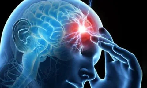 Chóng mặt, buồn nôn: Dấu hiệu đột quỵ tiểu não dễ nhầm với rối loạn tiền đình