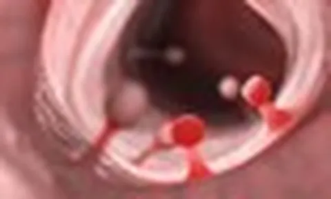 3 người đàn ông trong một gia đình cùng mắc ung thư đại trực tràng: Bác sĩ Bệnh viện Bạch Mai cảnh báo