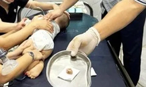 Bé trai 16 tháng tuổi tím tái, suy hô hấp vì hóc hạt chôm chôm