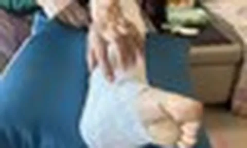 Xem nhẹ nốt ruồi ở nơi cực hiếm ai để ý, người phụ nữ "hối không kịp" vì ung thư đã di căn