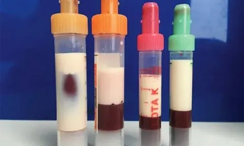 Bé trai 5 tuổi máu "trắng đục như sữa" vì thường xuyên ăn món canh quen thuộc