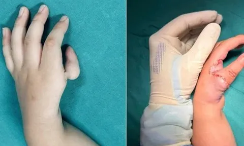 Bé gái được ‘tạo ngón cái mới’ từ ngón trỏ