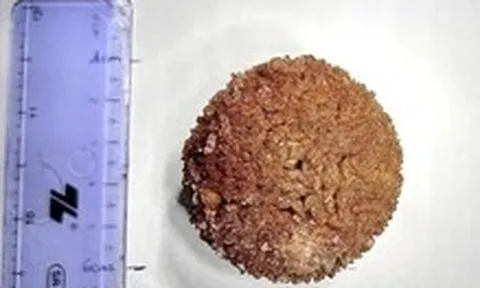 Người đàn ông ở Vĩnh Long mang sỏi niệu quản 'khổng lồ' suốt 20 năm