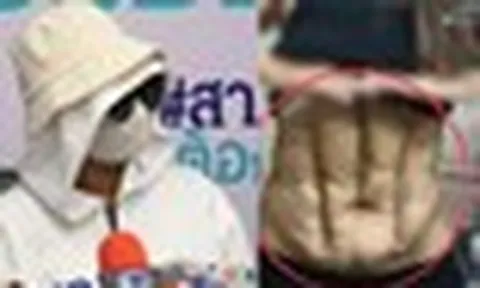 Phần bụng biến dạng của người phụ nữ sau ca phẫu thuật "cơ bụng số 11" giá rẻ tại phòng khám nổi tiếng Thái Lan
